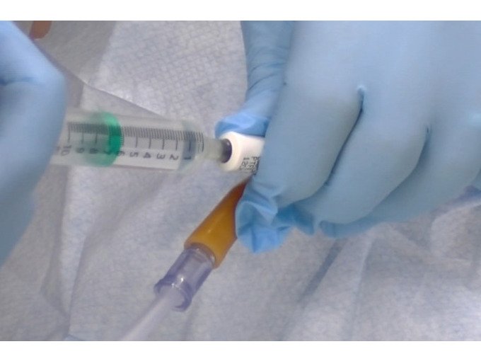 An Understanding of âSuprapubic Catheter Care