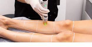 Level 4 Laser and IPl Treatments