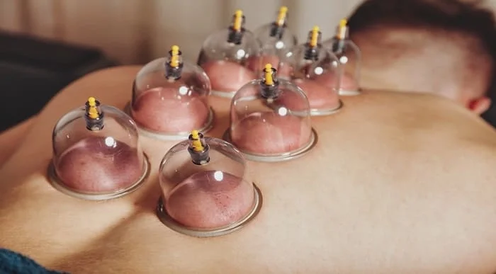Cupping Therapy Masterclass