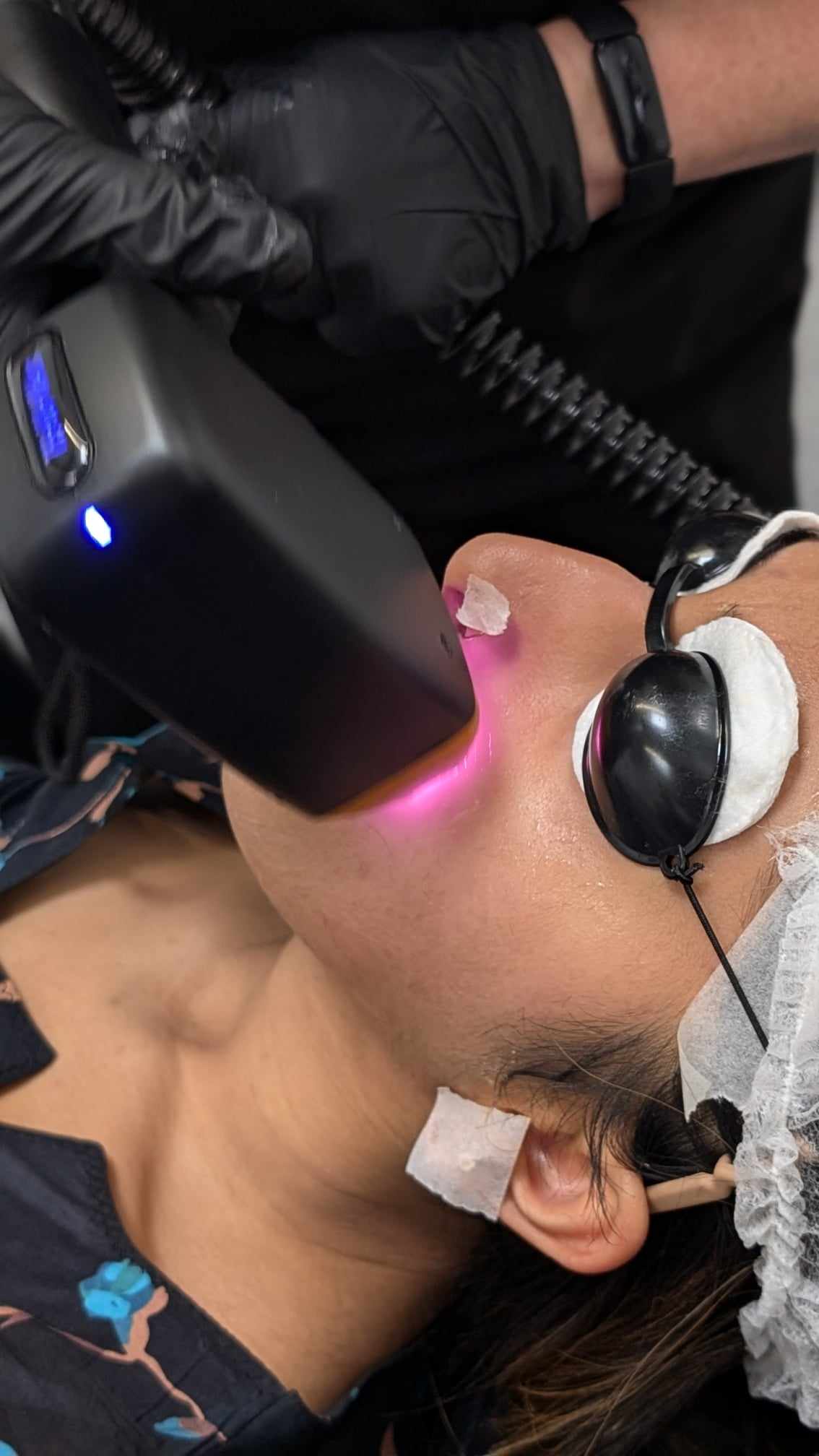 Level 4 - Combination Course - Laser Tattoo Removal & Diode Laser Hair Removal Training Course - Includes Your Dual Picoway and 808nm Laser Machine