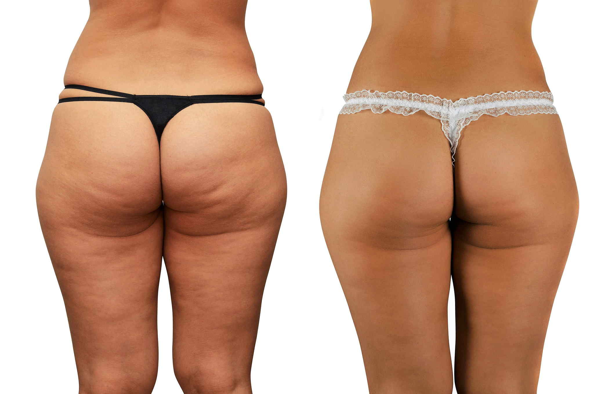 Combined Lipo-Cavitation & Radio Frequency – Diamond Aesthetic