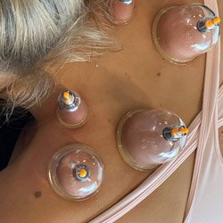 Dry Cupping CPD Course