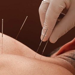 Dry Needling CPD Course