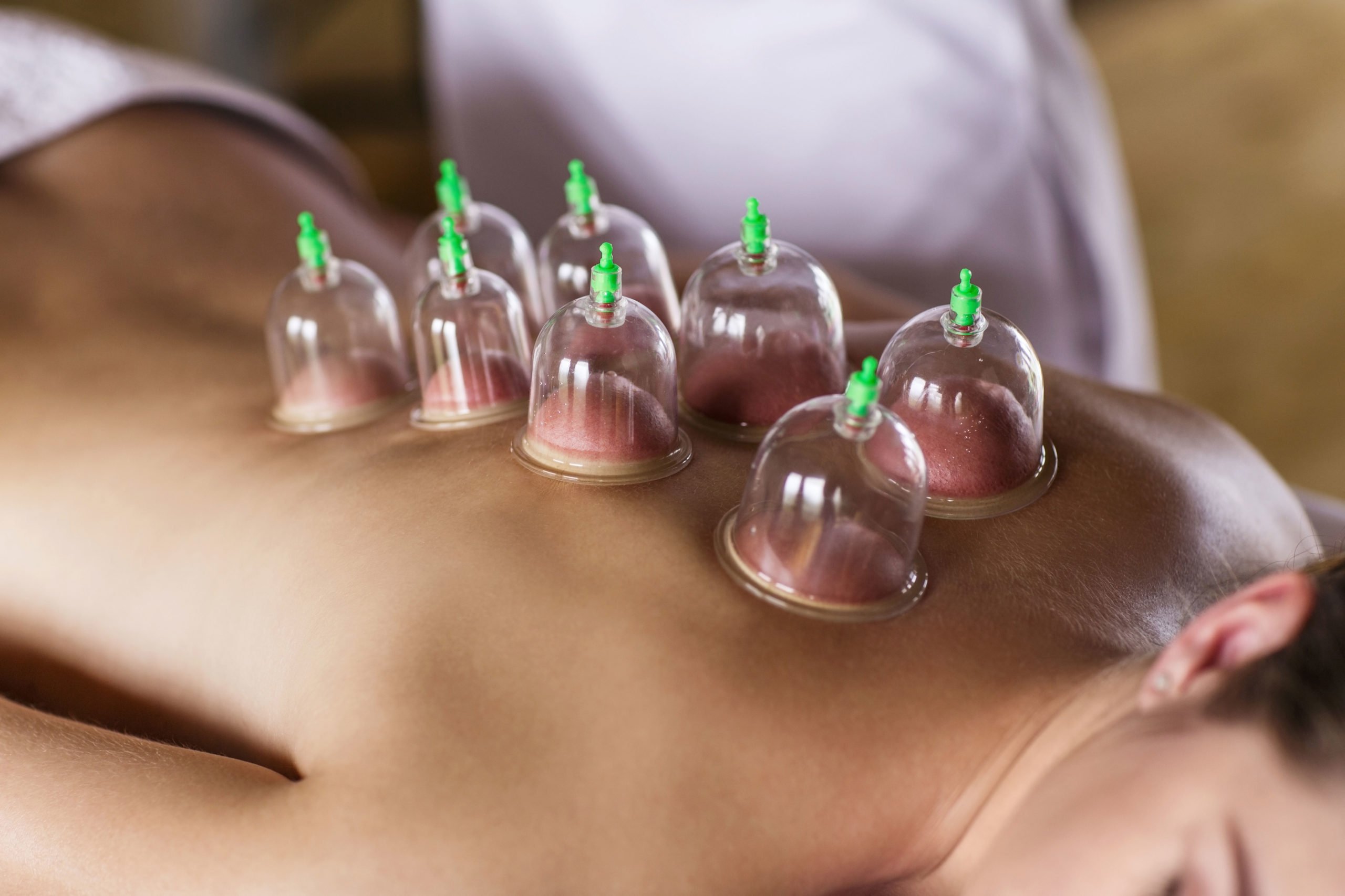 Diploma in Cupping Massage Therapy