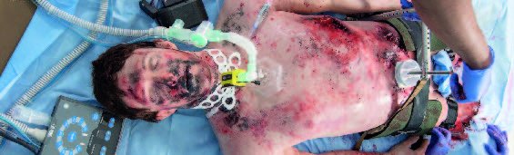 Stop the Bleed + Haemorrhage control and airway management